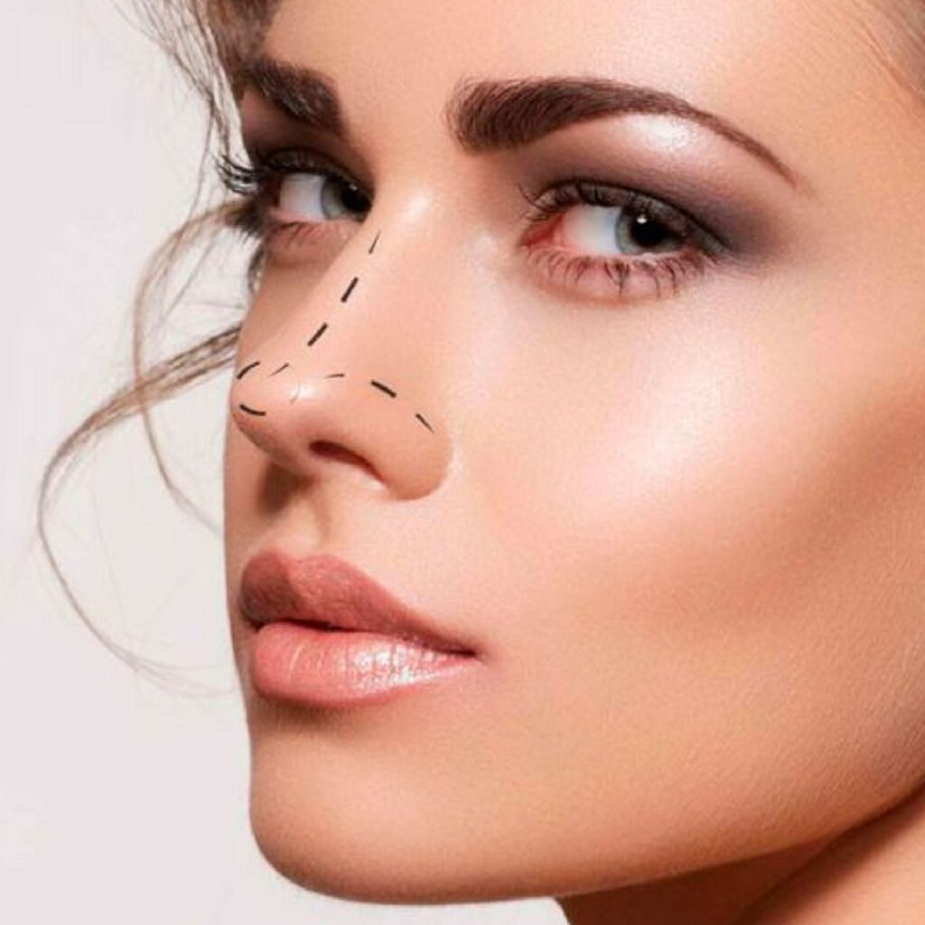 rinoplastia