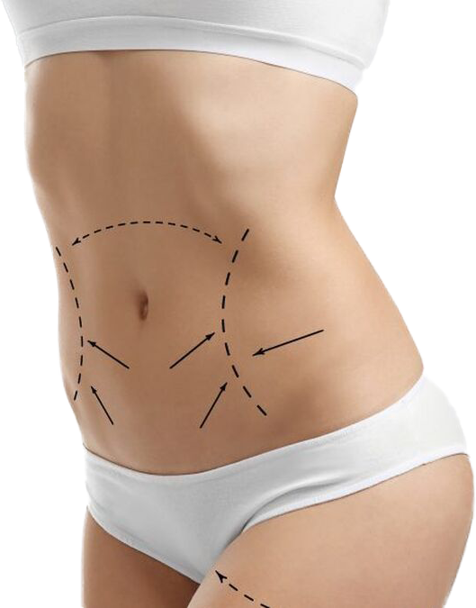 Liposucción
